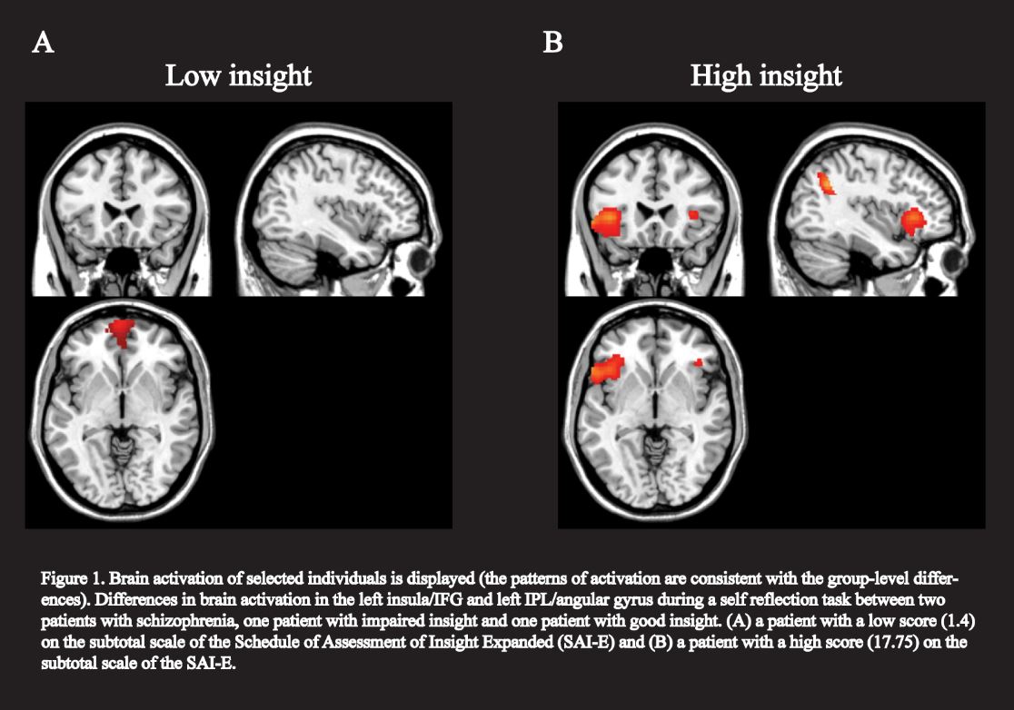 anosognosia-brains