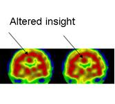 anosognosia3