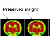 anosognosia4